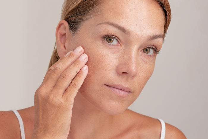 Acne prone